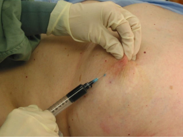 breast sentinel node injection Breast sentinel node injection